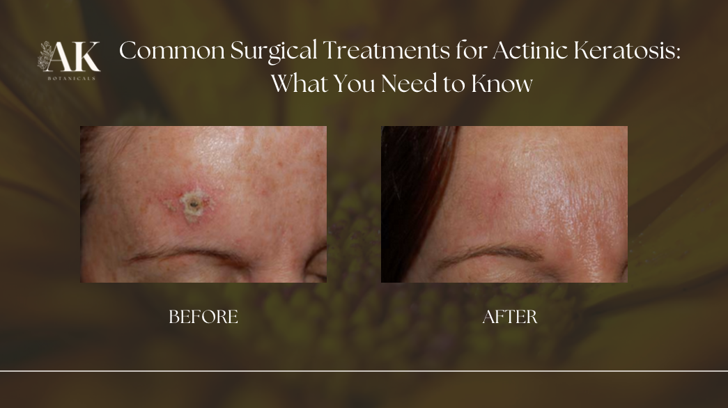 Common Surgical Treatments for Actinic Keratosis: What You Need to Know