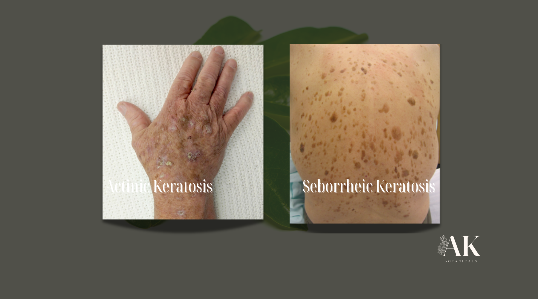 Actinic Keratosis vs. Seborrheic Keratosis