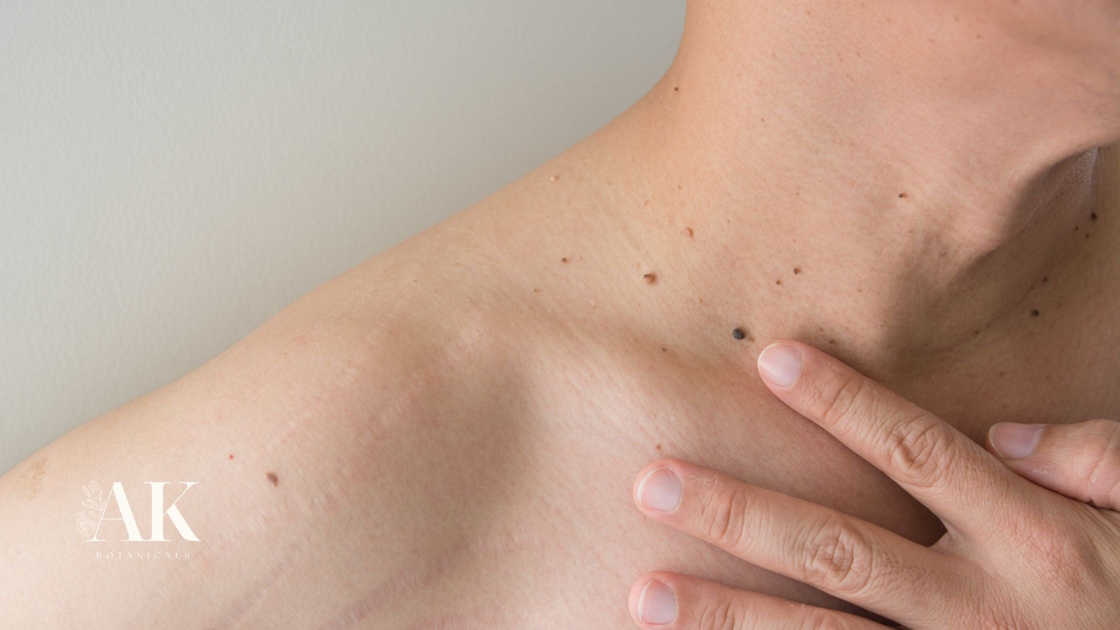 Sun damaged skin