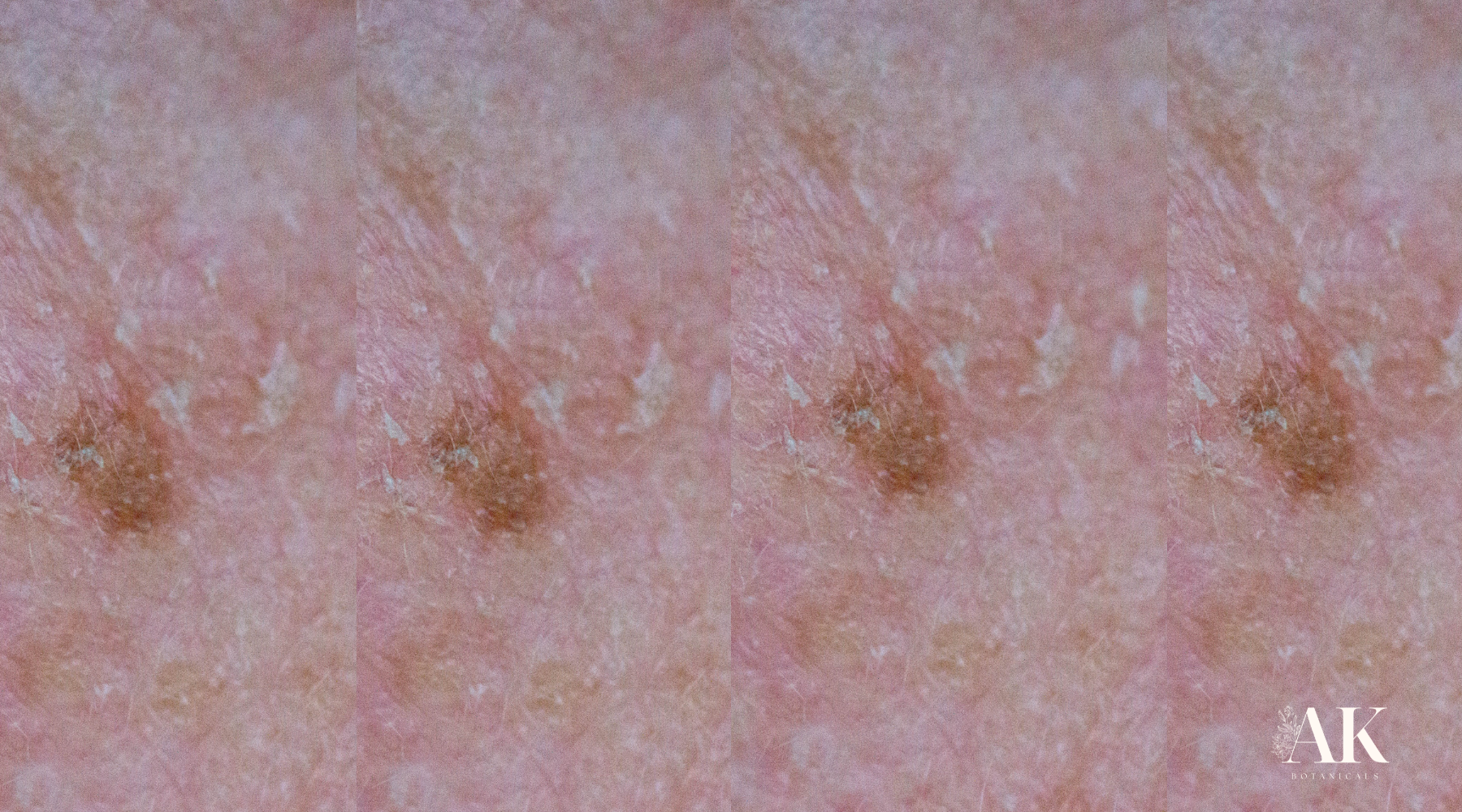 When a Single Actinic Keratosis Spot Turns Into Many