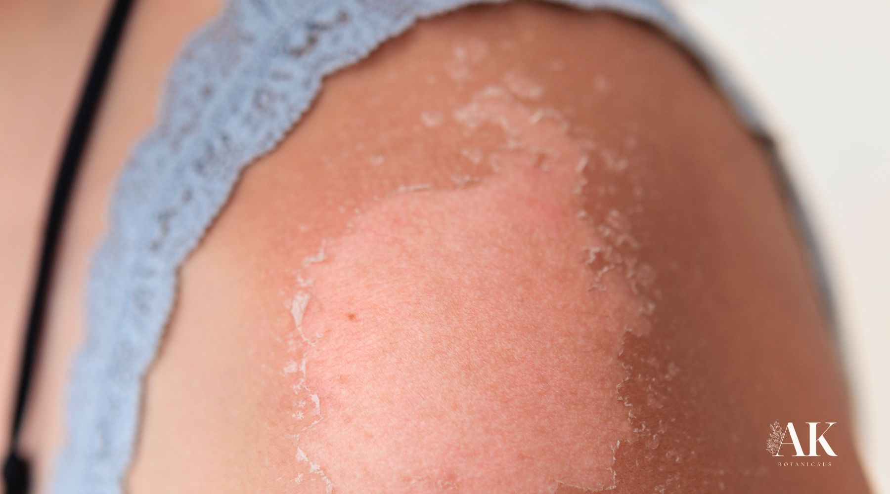 Natural Ways to Heal Sun-Damaged Skin with Holistic Approaches for Actinic Keratosis