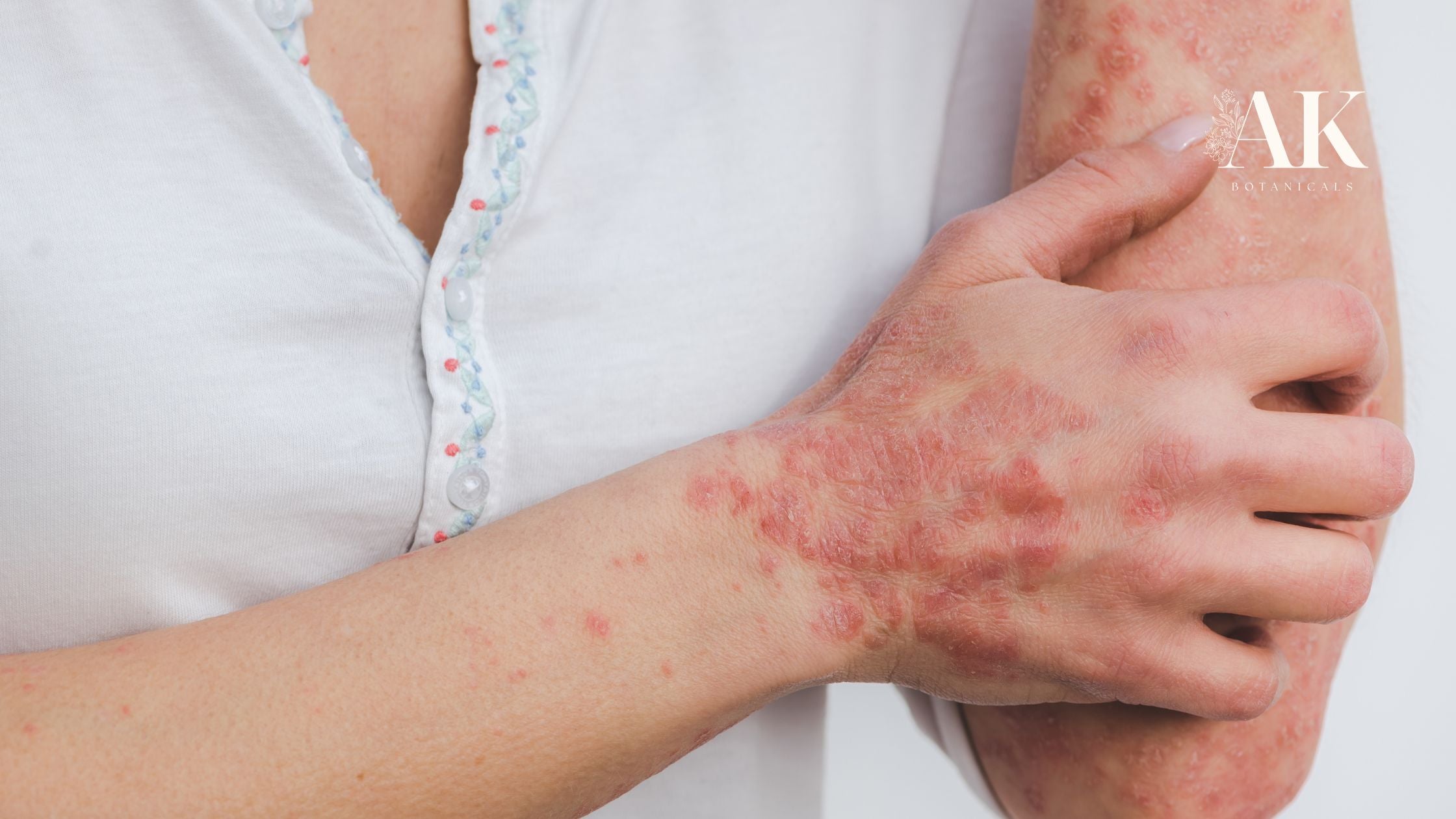 Close-up of a person’s forearm and hand showing red, scaly patches on the skin, commonly associated with plaque psoriasis or actinic keratosis.