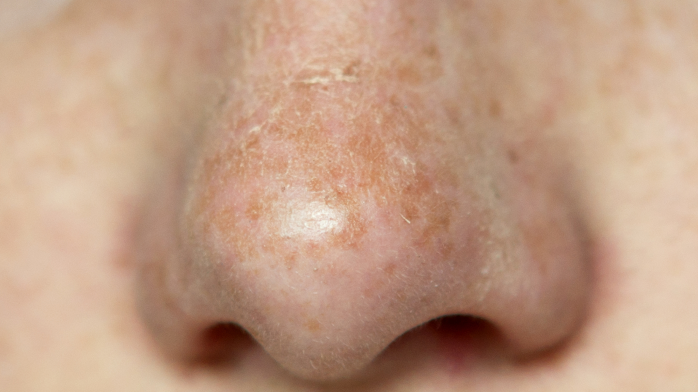 Close-up of a human nose showing sun-damaged skin, highlighting early signs of actinic keratosis or basal cell carcinoma.