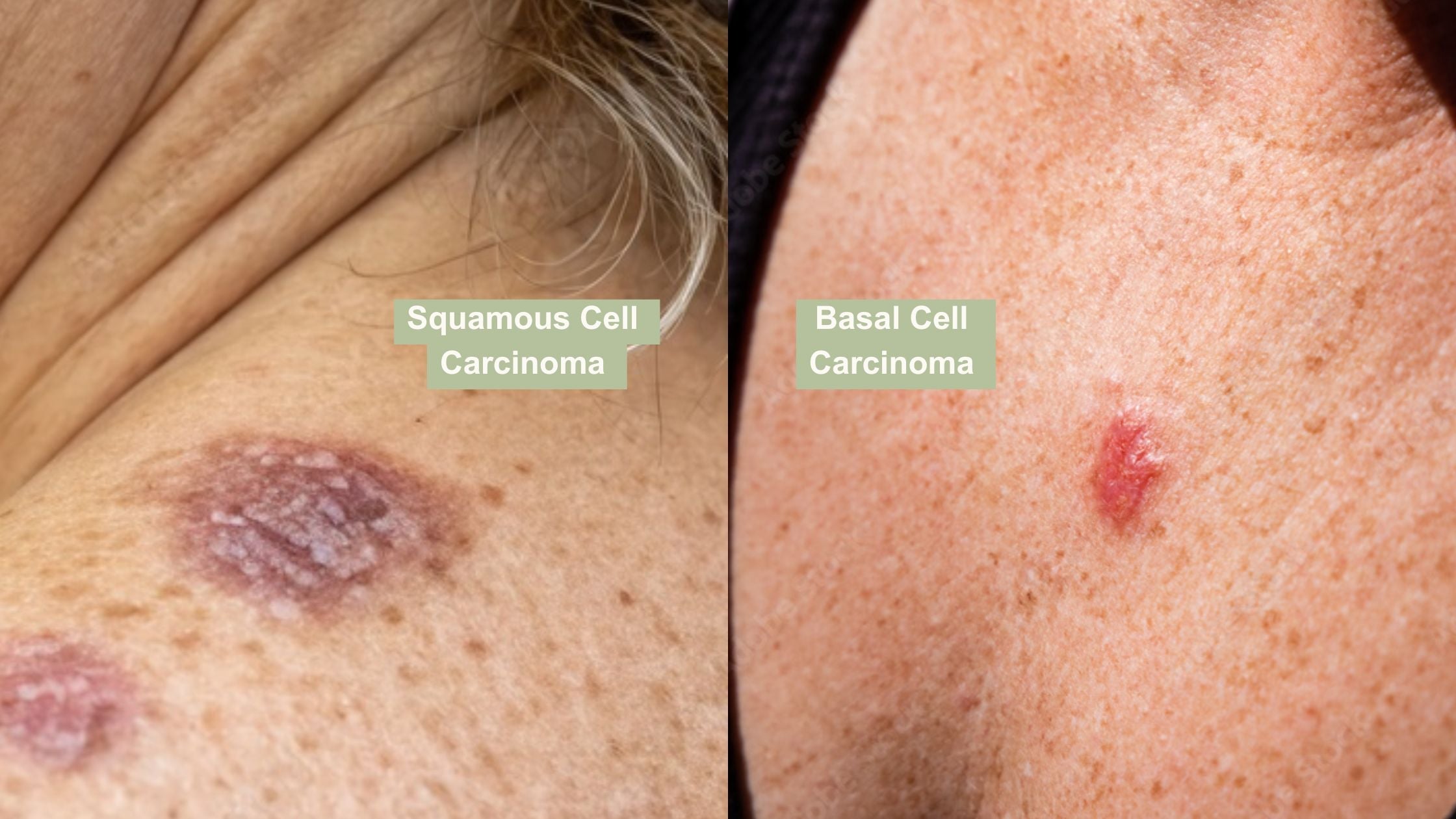 Side-by-side image showing basal cell carcinoma as a shiny bump and squamous cell carcinoma as a rough, scaly patch.